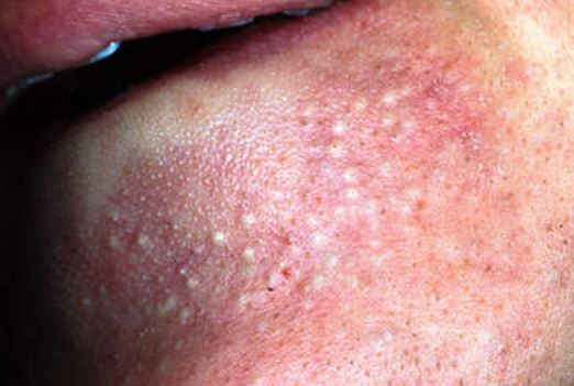 Hard White Head Pimple | www.pixshark.com - Images ...