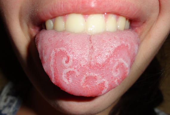 What are some good mouthwashes for canker sores?