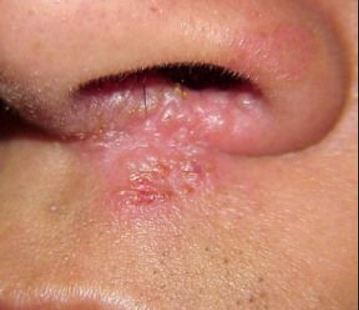 Steroid treatment for mouth sores