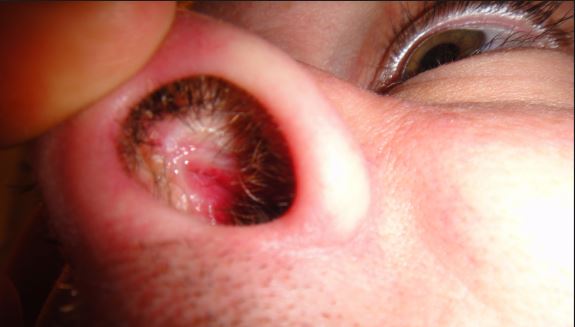 Sores in Nose, Around, Inside Nose Causes, Treatments ...