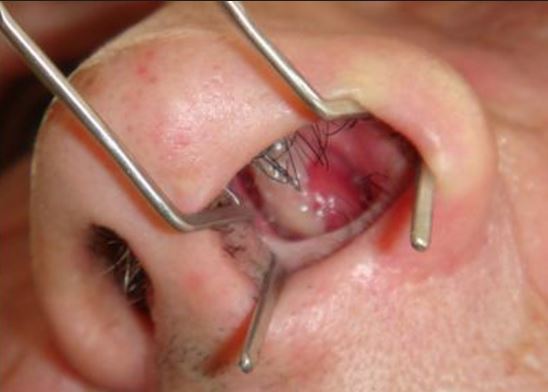 Is nasal polyp surgery serious?