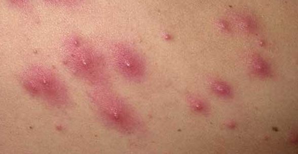 herpes lesions on buttocks