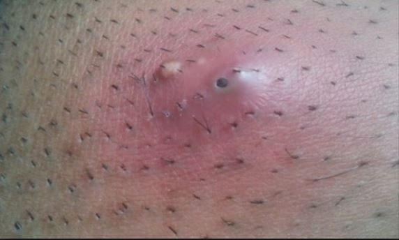 bumps on skin that look like pimples - MedHelp