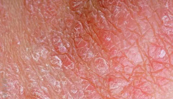 Skin Rash Penis 112