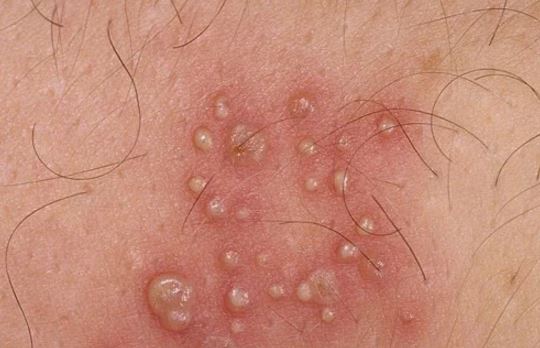A Blistering Rash, Could I have Shingles? | Natura Dermatology
