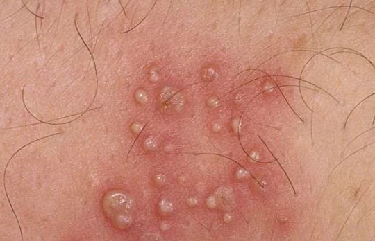 genital herpes rash