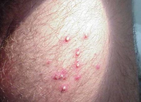 Hair On Shaft Of Penis 69