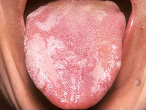 White Lesion In Mouth 80