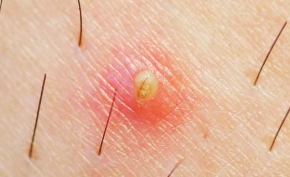 What is an infected hair follicle?