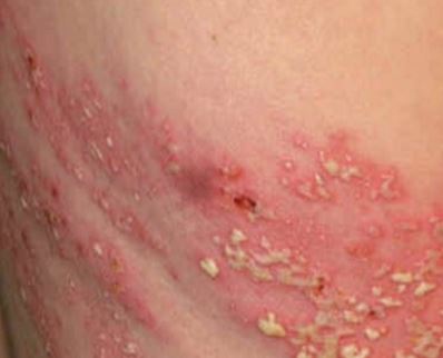 Shingles under breast