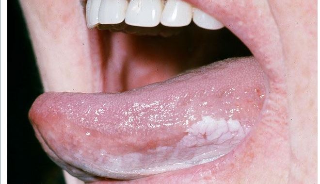 White Spots Inside Mouth 69