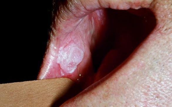 White Lesion In Mouth 103