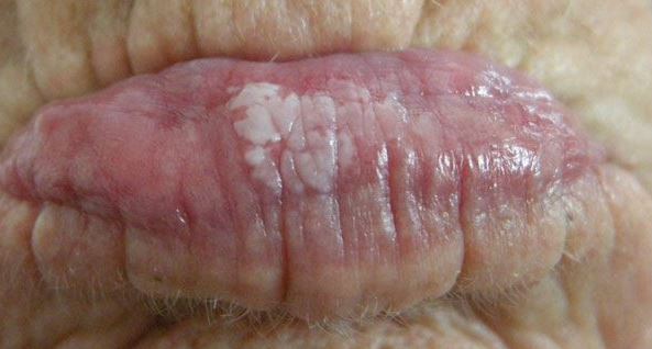 White patches on lips from leukoplakia