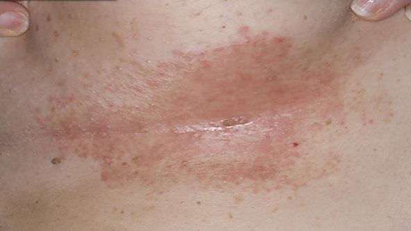 Hidradenitis suppurativa | American Academy of Dermatology