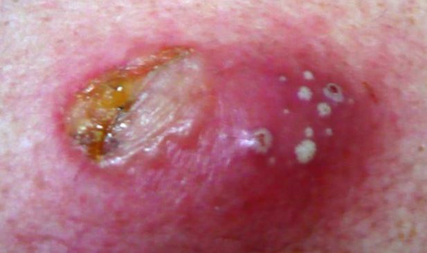 What are some causes of cysts?