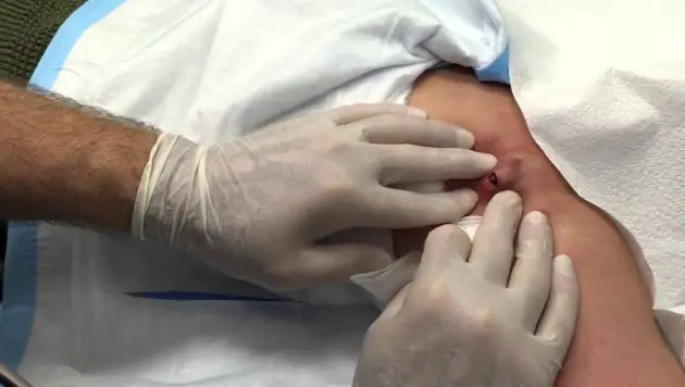 Infected sebaceous cyst removal through surgery