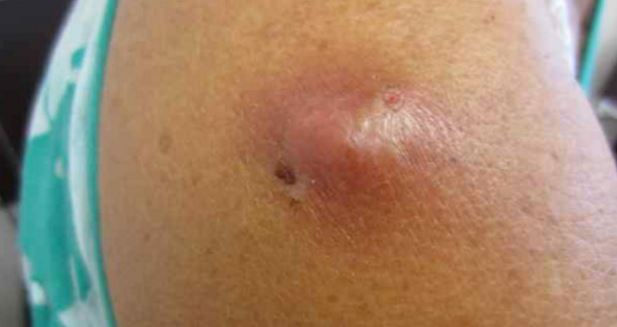 Pus-filled cysts are likely to be infected