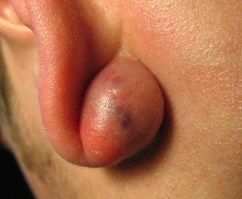 Sebaceous cyst behind ear