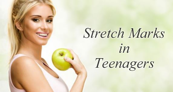 stretch marks teenagers rid fast silver appear lower horizontal stripes common naturally prevent them treat skin fitneass