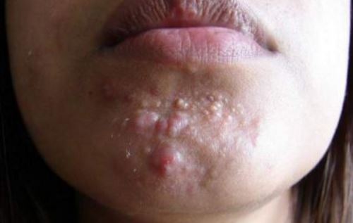 Acne breakouts on chin signs you are pregnant