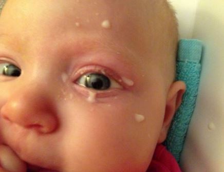 Breast milk can help get rid of bacterial pink eye fast