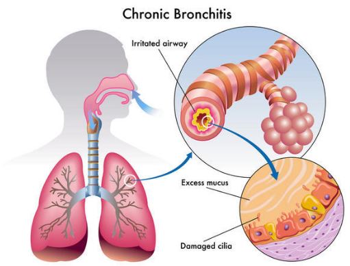 What are some causes of a chronic cough with white phlegm?