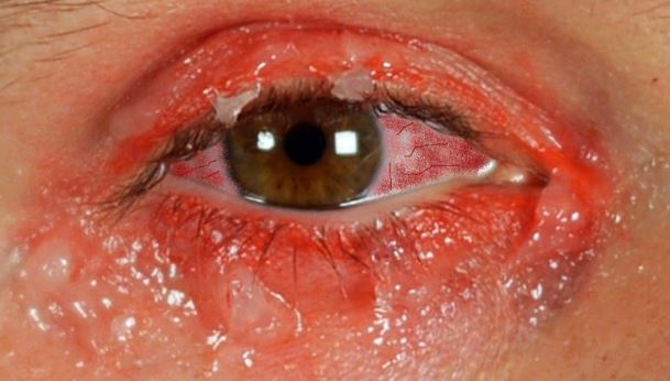 How To Naturally Treat Conjunctivitis How To Naturally Treat Conjunctivitis