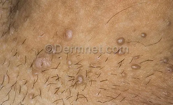 Brown Spots On The Penis 81