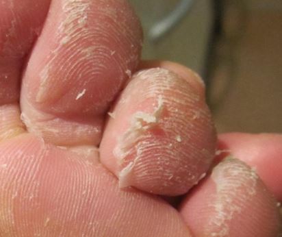 Dry itchy peeling skin on feet