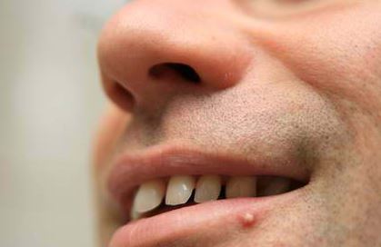 can you get pimples on your vag lips can you get pimples on your vag lips