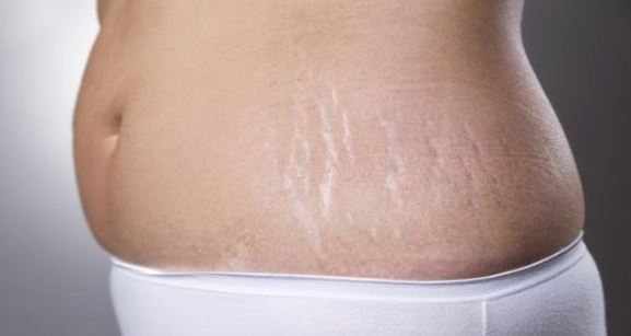 White Stretch Marks Meaning on Buttocks, Thighs, Remedies ...