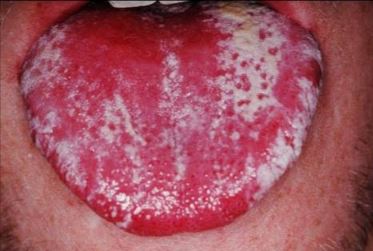 Oral thrush causes white patches in mouth