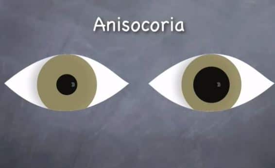 unequal pupil size infants