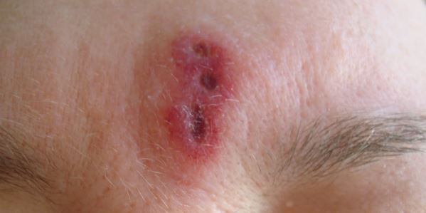 Wolf spider bite on human