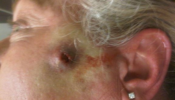 Wolf spider bite pictures and images
