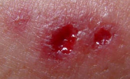 Symptoms and side effects of a fresh bite by a wolf spider