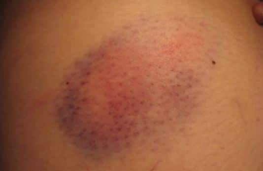 Pictures Of Bruises On Skin 87