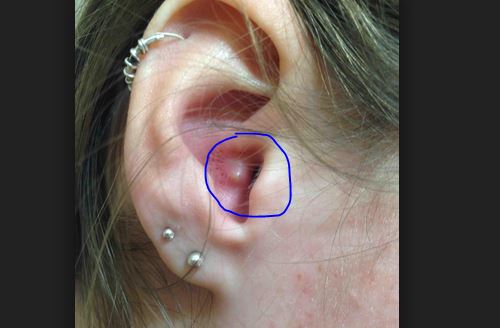 Bump in Ear, Inside Ear Lobe, Canal, Painful Small Hard 