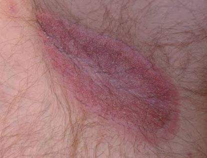 How to get rid of jock itch fast