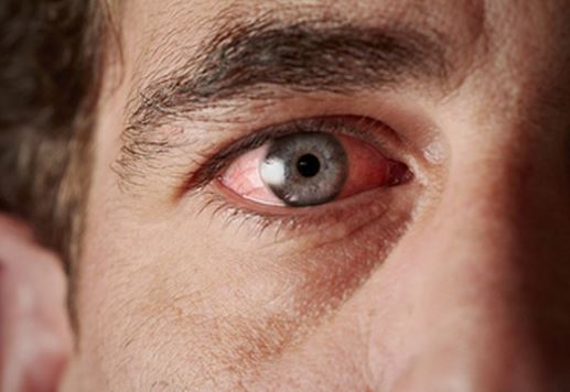Is pink eye airborne and contagious