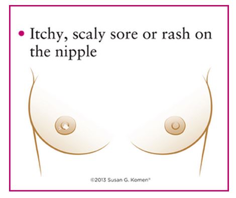 Anorexic Porn Tube Itchy Dry Nipples