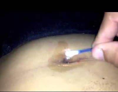 Belly button discharge is likely to be a symptom of urachal cyst