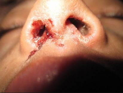 bloody nose causes of scabs in nose how to heal them fast treat cure fast bloody nose causes of scabs in nose how to heal them fast treat cure fast