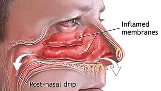 Sebaceous Filaments on Nose, Removal, How to Get Rid 