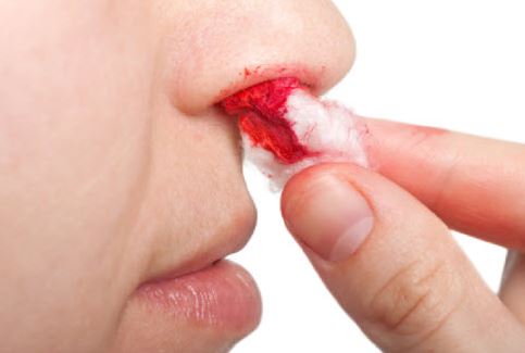 nose-bleeding-can-lead-to-scabbing