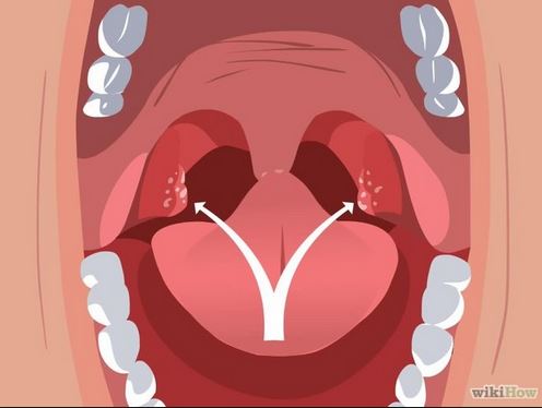 Tonsil stone illustration