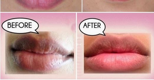 How to Get Rid of Dark Lips Fast, Permanently, Naturally 