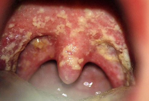 Green Spots On Throat 111