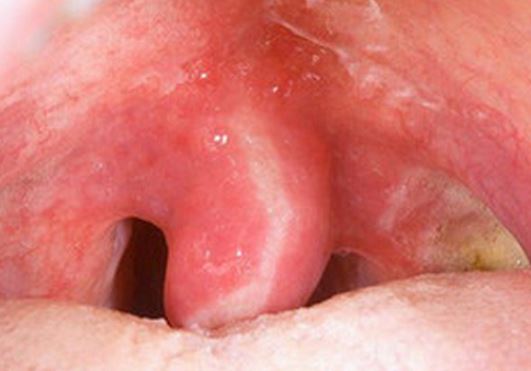 Enlarged Throat 15