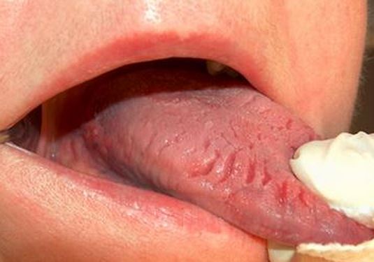 adderall bump on tongue